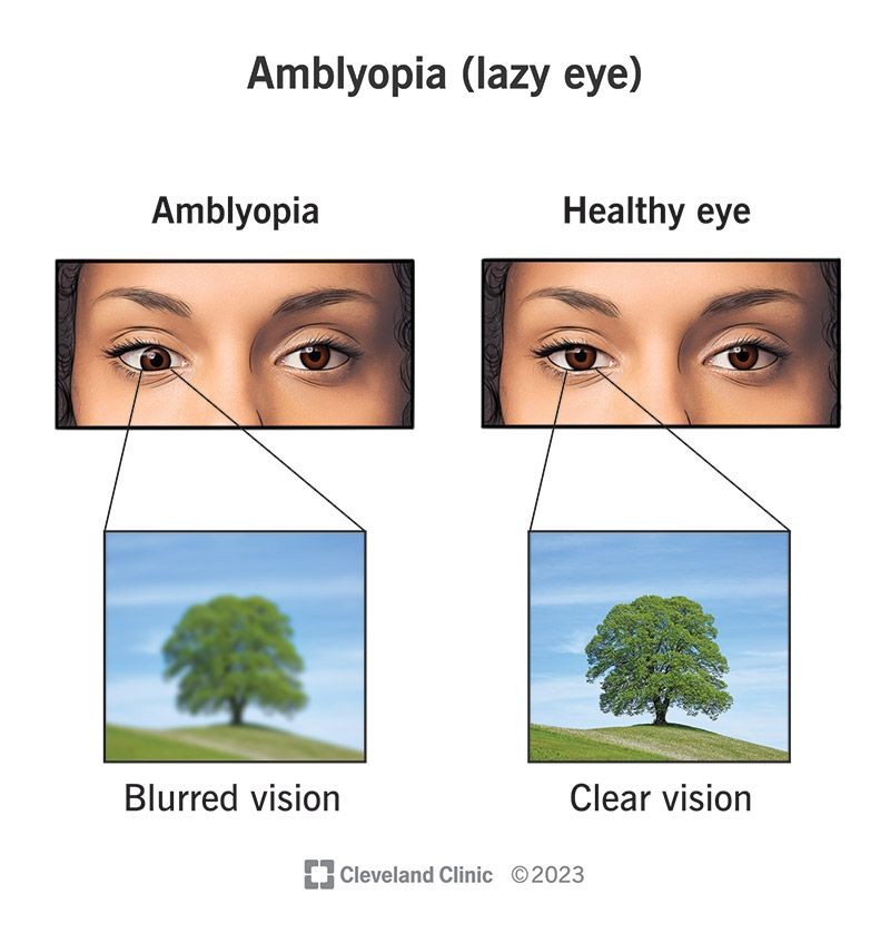 Amblyopia Lazy Eye Causes Medication Surgery Treatment