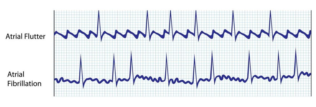 Atrial Flutter vs Atrial Fibrillation AFib Differences Similarities Symptoms