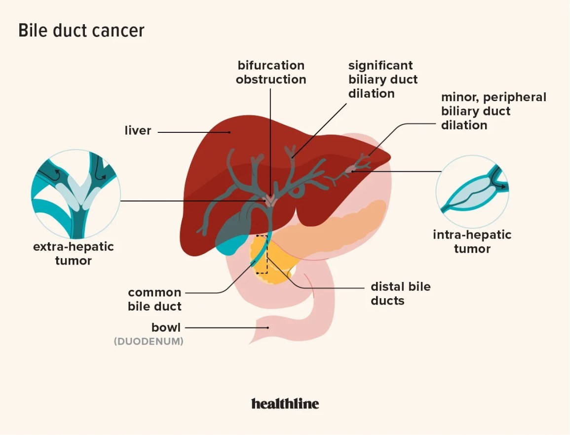 Bile Duct Cancer Symptoms Survival Rate Prognosis Causes Treatment