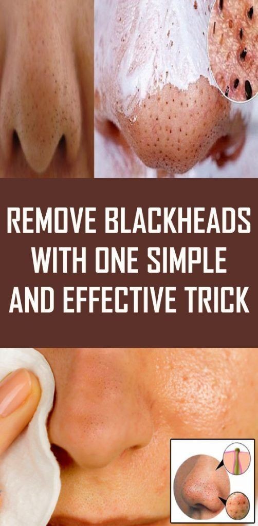 Blackheads Removal Symptoms Causes Treatment Prevent