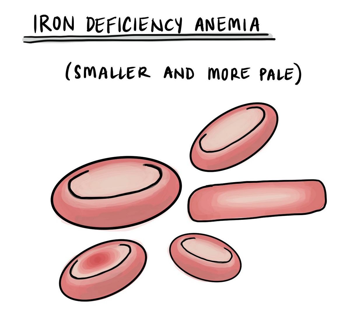 Carbonyl Iron Anemia Uses Warnings Side Effects Dosage