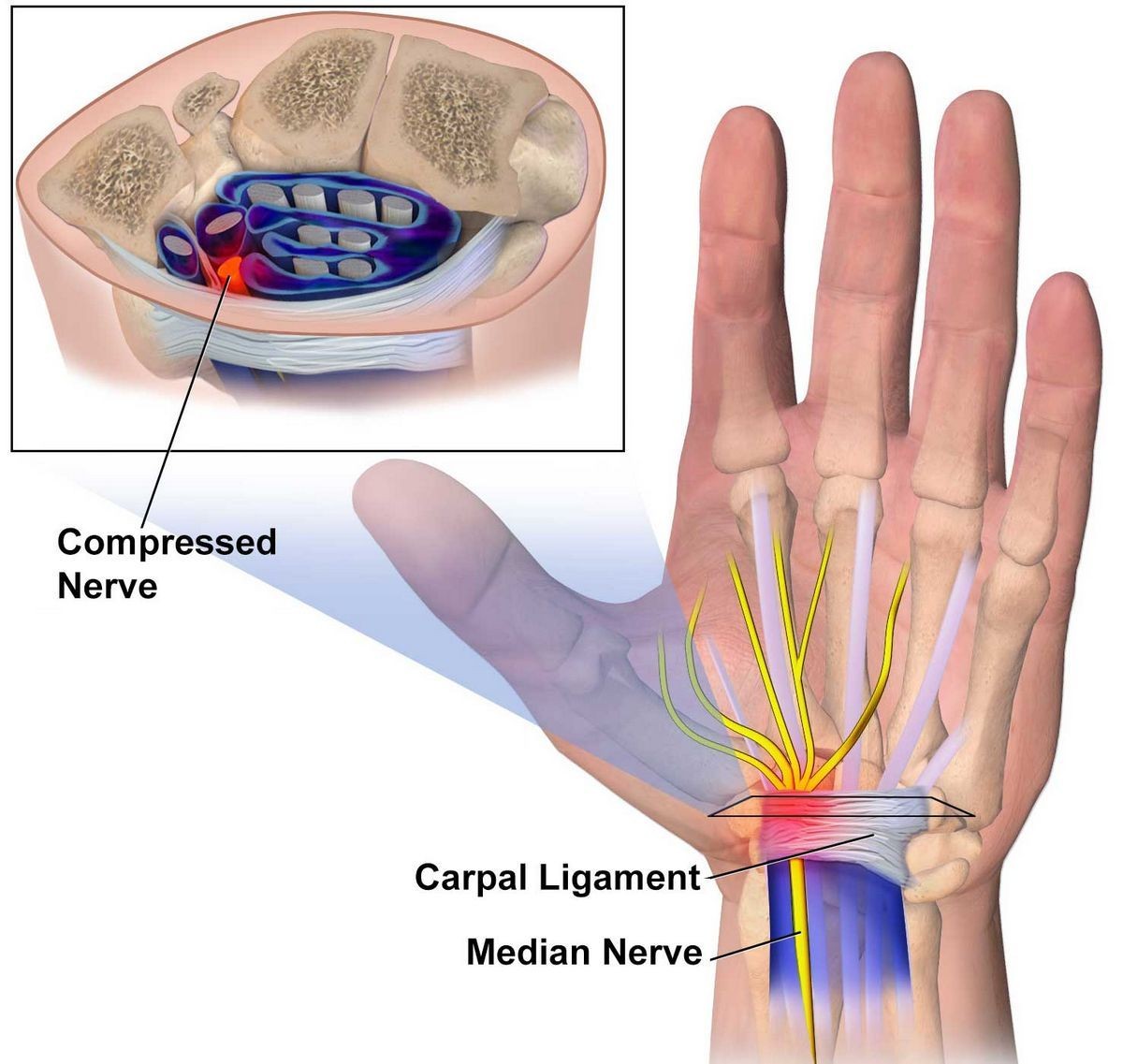 Carpal Tunnel Syndrome Causes Symptoms Treatment Medications Prevention