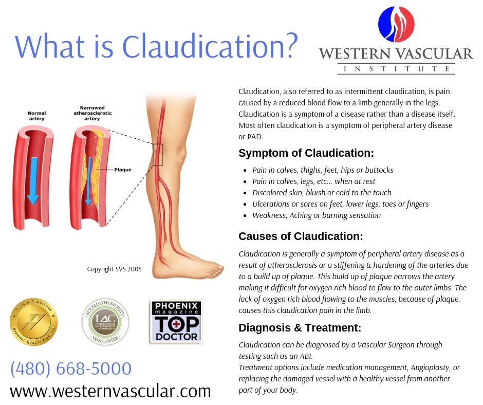 Claudication Symptoms Causes and Treatment
