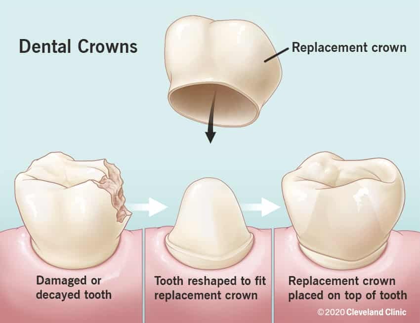 Dental Crowns Types Purpose Procedure Cost Tooth Pain