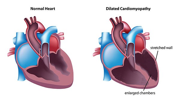 Dilated Cardiomyopathy Symptoms Treatment