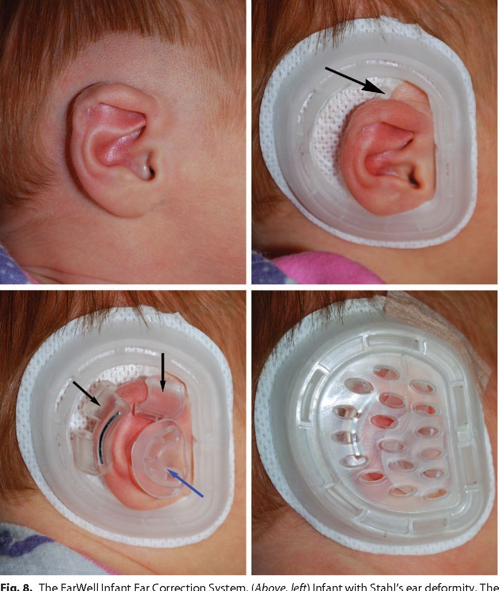 Ear Tubes Surgery Medical Term Procedure in Kids Adults