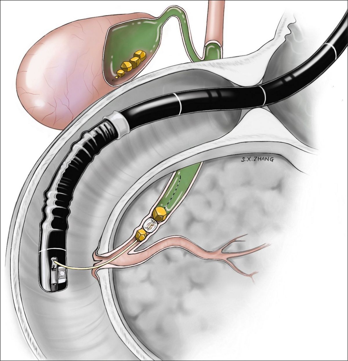 Endoscopic Ultrasound Pancreas Procedure Indications Risks