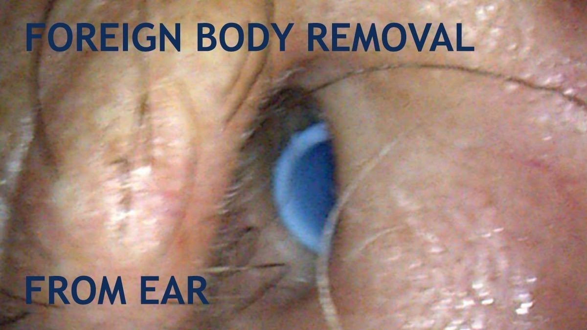 Foreign Body in the Ear Types Symptoms Treatment Removal