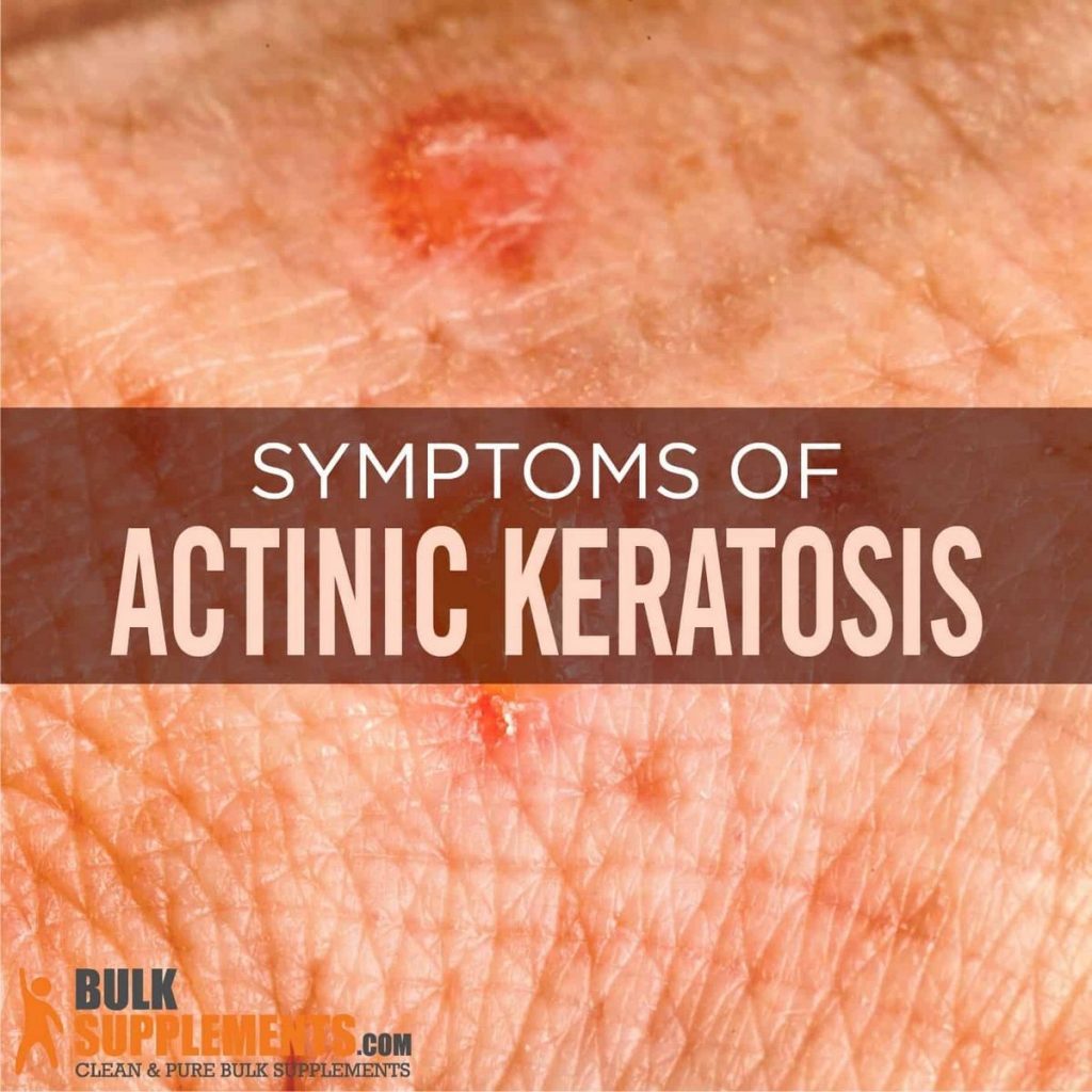 Actinic Keratosis Treatment Symptoms Causes How to Remove