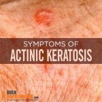Actinic Keratosis Treatment Symptoms Causes How to Remove
