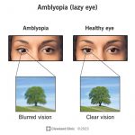 Amblyopia Lazy Eye Causes Medication Surgery Treatment