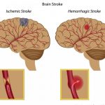 Aneurysm vs Stroke Which Is Worse