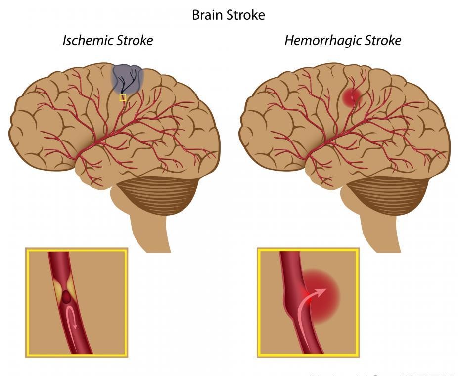Aneurysm vs Stroke Which Is Worse