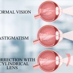 Astigmatism Glasses Lens Vision Test Causes Treatment