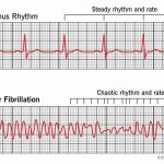 Atrial vs Ventricular Fibrillation Differences Similarities