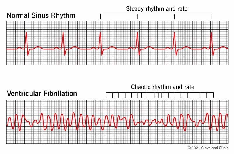 Atrial vs Ventricular Fibrillation Differences Similarities