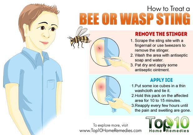 Bee Wasp Sting Symptoms Types Reaction Treatment at Home