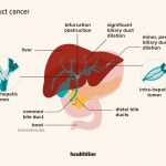 Bile Duct Cancer Symptoms Survival Rate Prognosis Causes Treatment