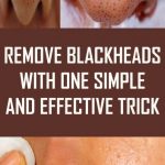 Blackheads Removal Symptoms Causes Treatment Prevent