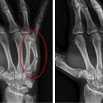 Broken Finger Fracture Treatment Symptoms Recovery Tip