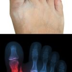 Broken Toe Fracture Symptoms Treatment Recovery Time