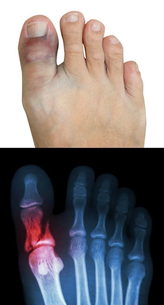 Broken Toe Fracture Symptoms Treatment Recovery Time