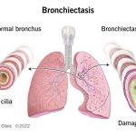 Bronchiectasis Types Causes Symptoms Diagnosis Treatment