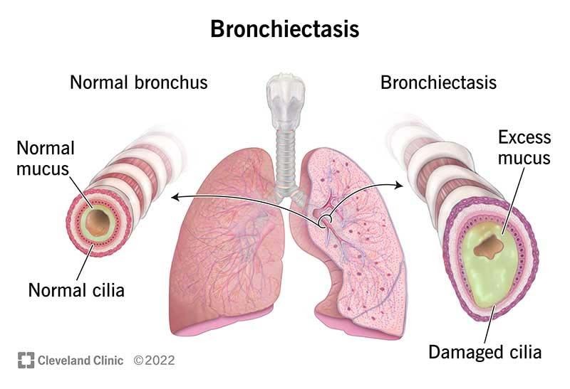 Bronchiectasis Types Causes Symptoms Diagnosis Treatment