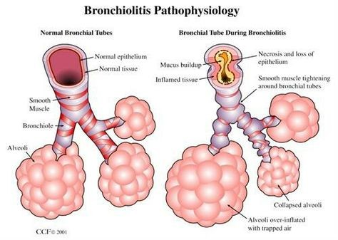 Bronchiolitis Treatment Symptoms Risk Factors Definition