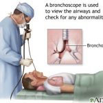 Bronchoscopy Indications Test Procedure Steps Side Effects