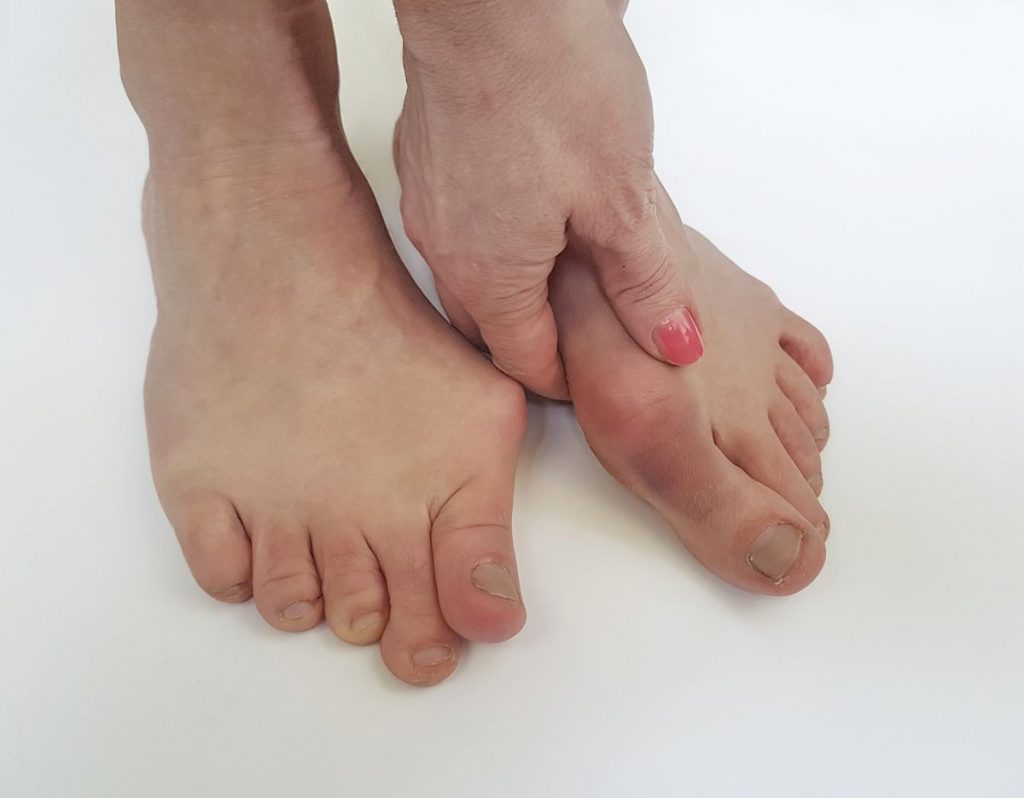 Bunion Causes Treatments Surgery Prevention