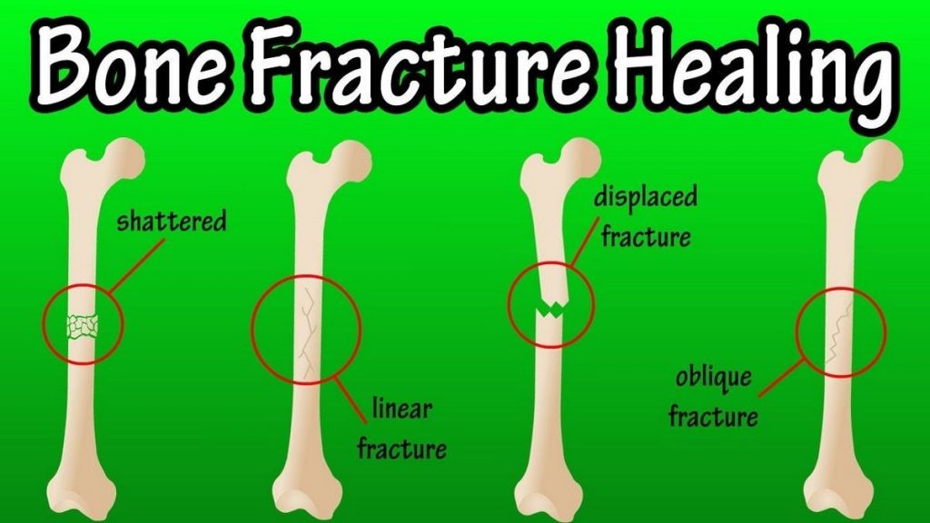 Can a Bone Fracture Heal on Its Own