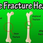 Can a Bone Fracture Heal on Its Own