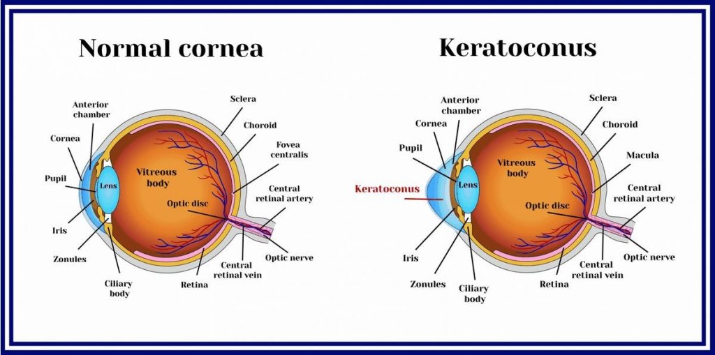 Can Keratoconus Be Cured Treatment Surgery