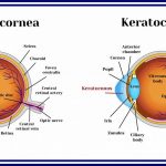 Can Keratoconus Be Cured Treatment Surgery