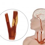 Carotid Artery Disease Symptoms Treatment Life Expectancy