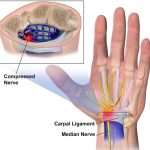 Carpal Tunnel Syndrome Causes Symptoms Treatment Medications Prevention