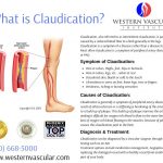 Claudication Symptoms Causes and Treatment