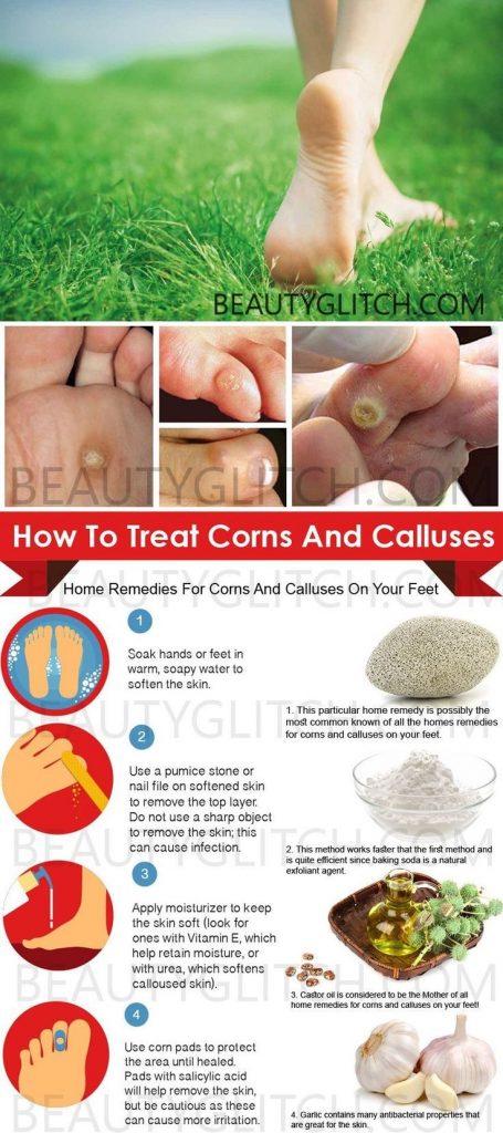 Corns and Calluses on Foot Types Pain Removal Treatment
