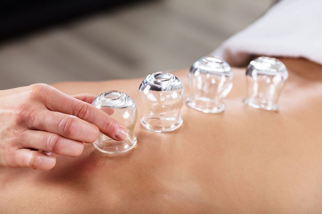 Cupping Therapy Types Benefits Side Effects