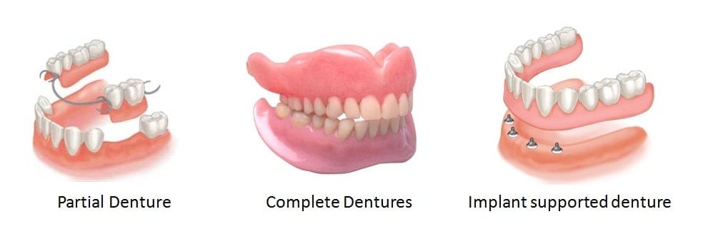 Dentures Types Costs Alternatives Care Insurance Implants