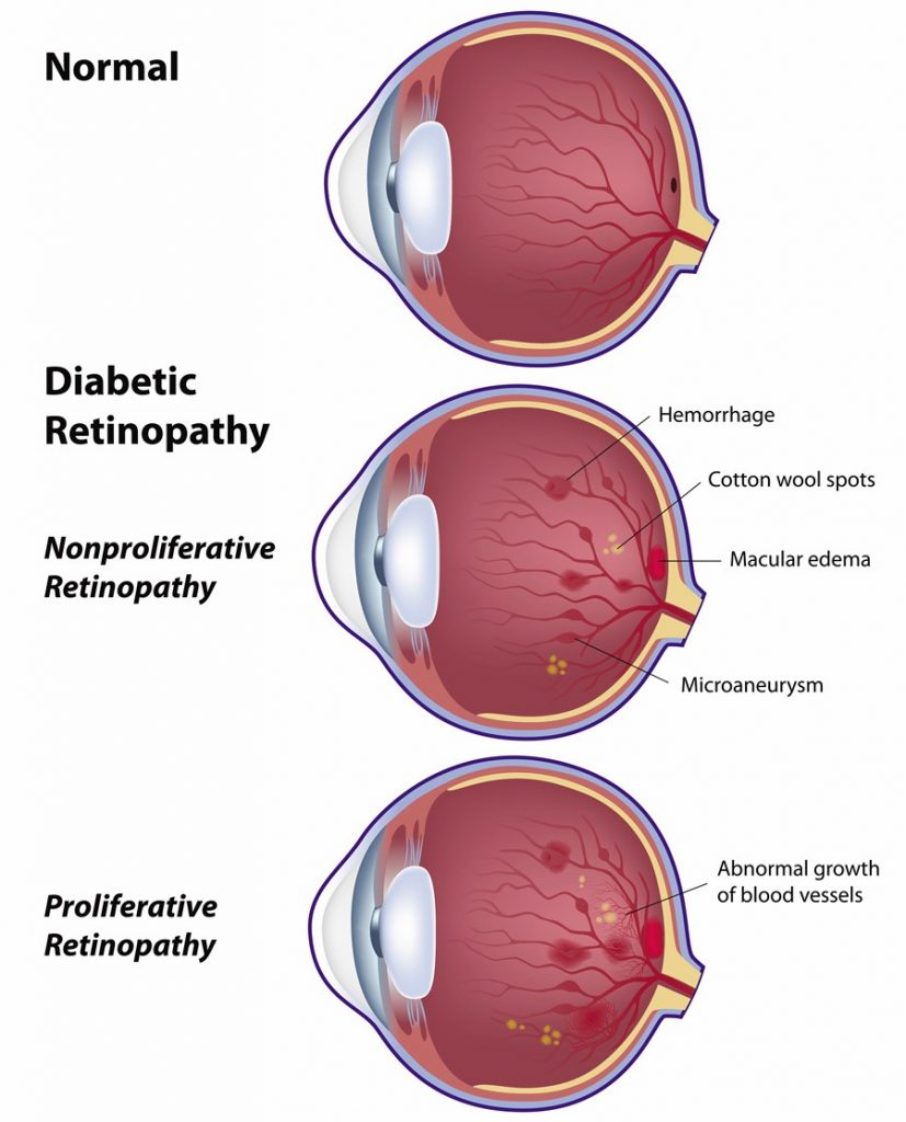 Diabetic Retinopathy Types Symptoms Prevent Treatment