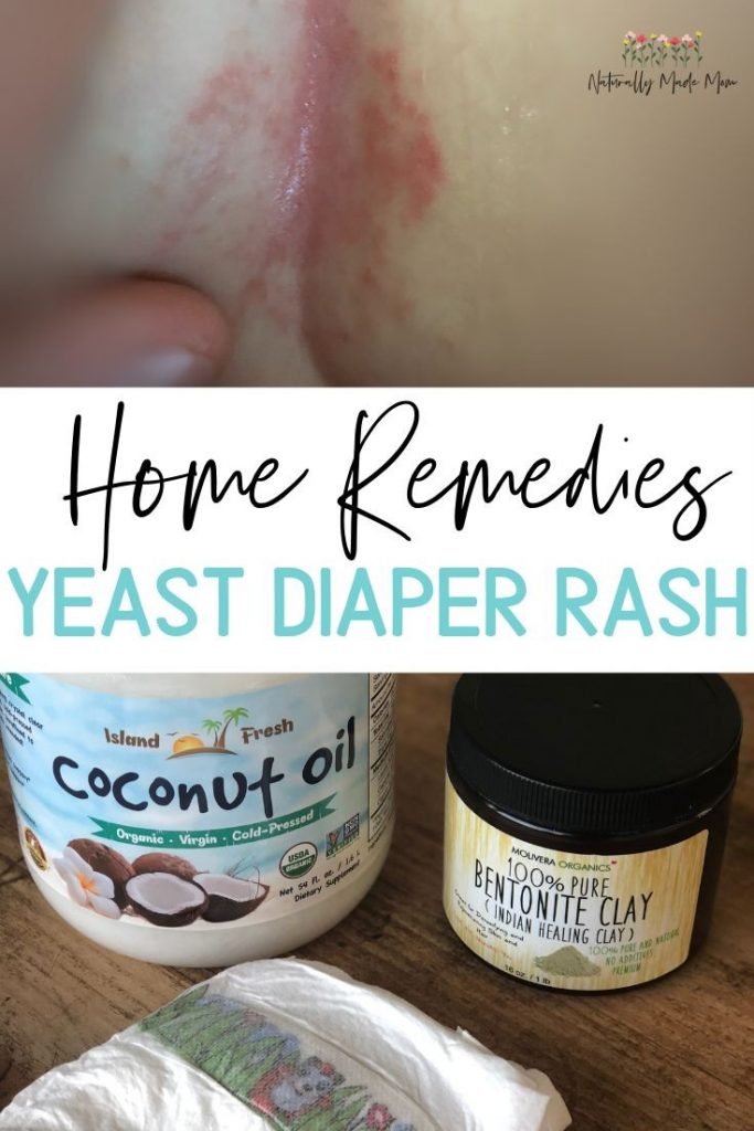 Diaper Rash Treatment Types Symptoms Causes Remedies