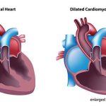 Dilated Cardiomyopathy Symptoms Treatment