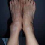 Dislocated Ankle Symptoms Treatment Recovery and Surgery