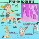 Does Prurigo Nodularis Ever Go Away Causes Symptoms Food to Avoid