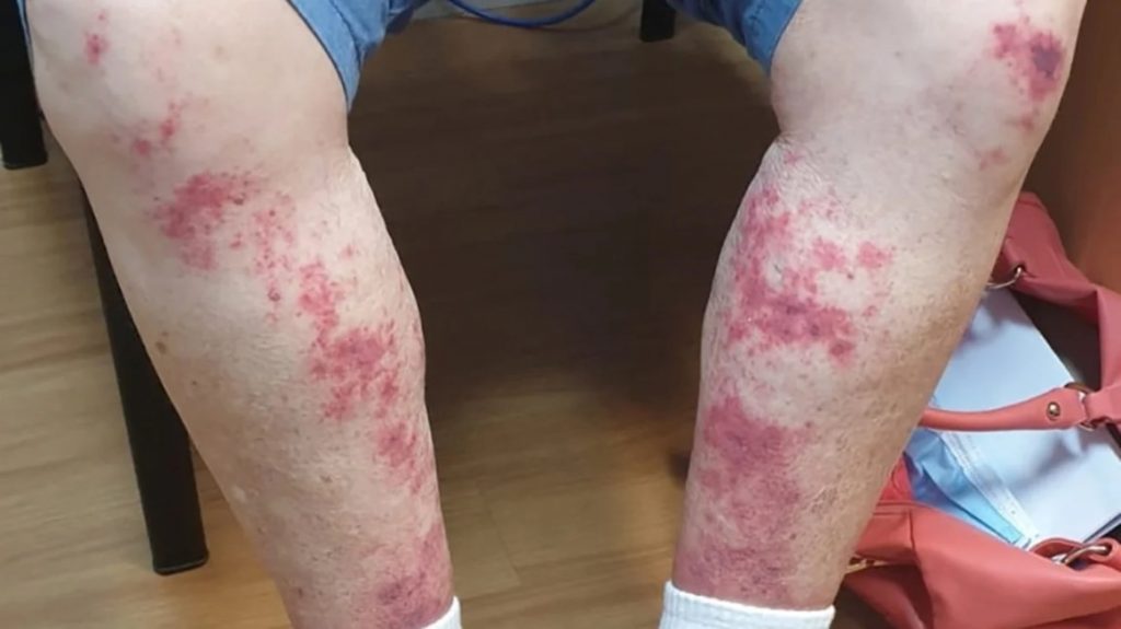 Early Stages of a Rheumatoid Vasculitis Rash Symptoms of RV