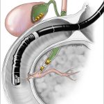 Endoscopic Ultrasound Pancreas Procedure Indications Risks