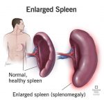 Enlarged Spleen Splenomegaly Symptoms Causes Treatment