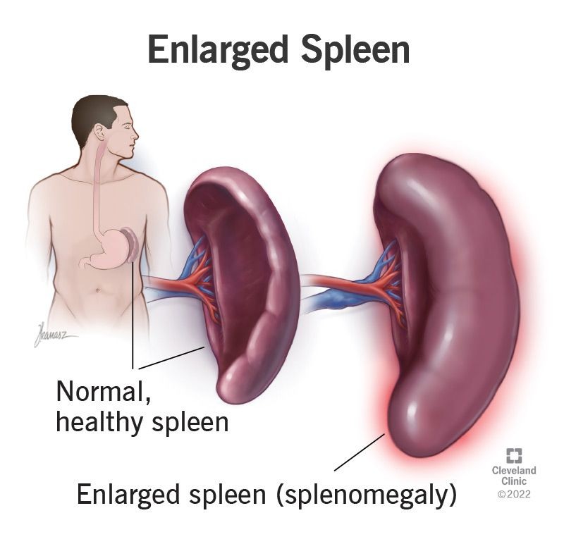 Enlarged Spleen Splenomegaly Symptoms Causes Treatment